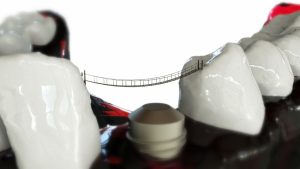 Sztuczne szczęki czy implant? Czyli gdy zęby są chore…